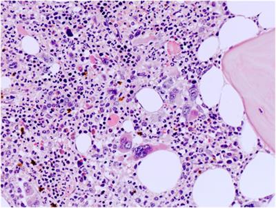 Frontiers Chronic myeloproliferative neoplasms with concomitant